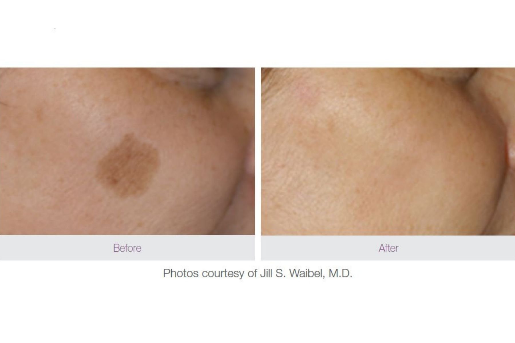 Pigmentvlekken verwijderen NVCG en Nvh logo's