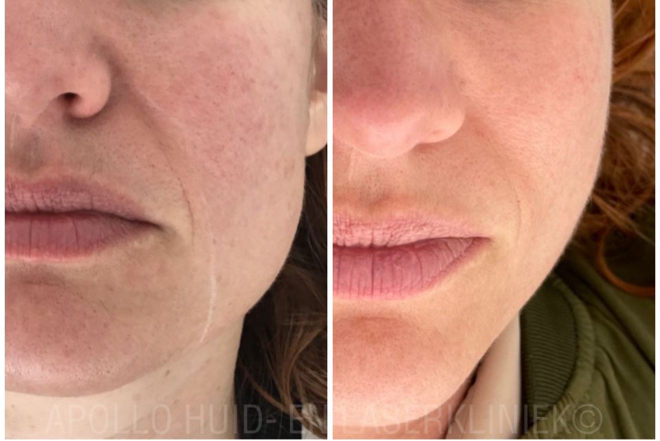 Hifu Behandeling Apollo Beauty Rotterdam Resultaat
