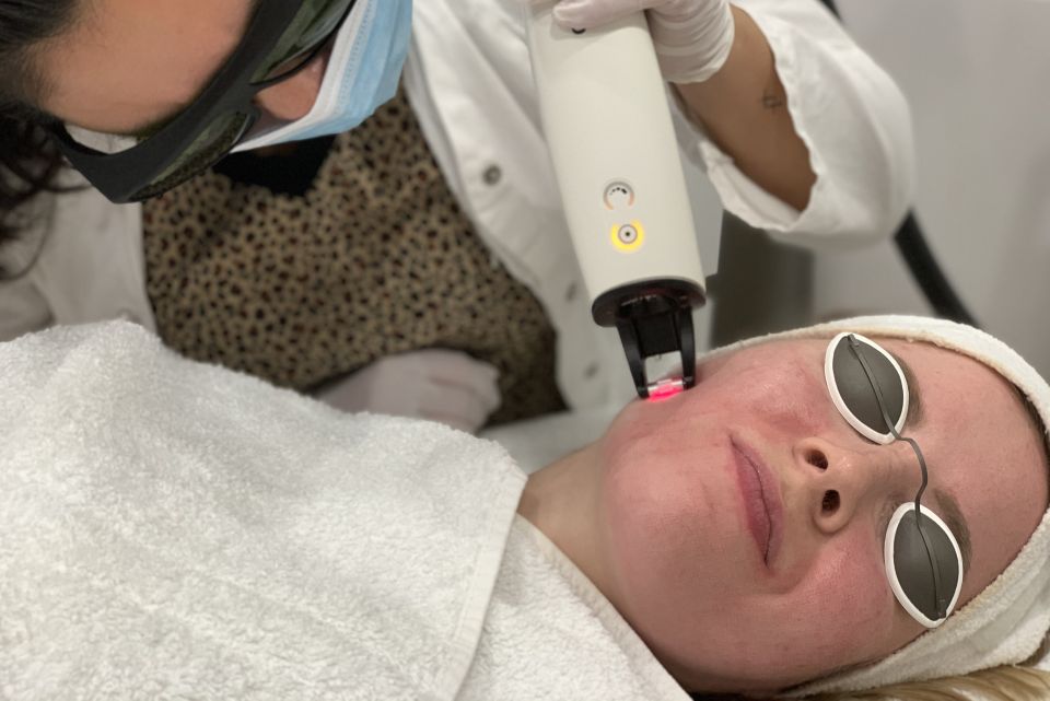 Fractional LASER Behandeling 2