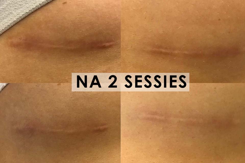 Verbetering van littekenweefsel na twee sessies met de Fractional Laserbehandeling bij Apollo Huid- en Laserkliniek.