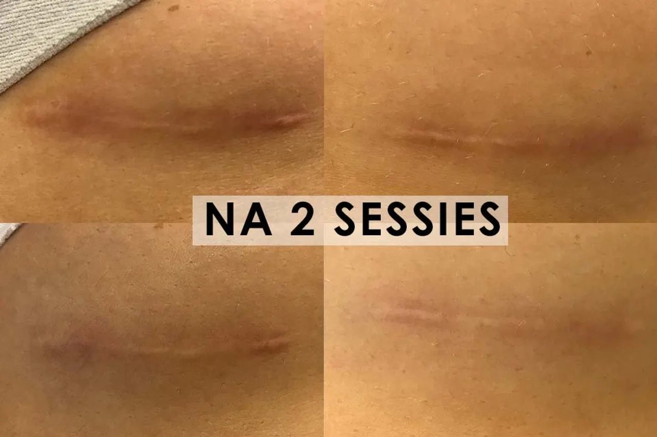 Verbetering van littekenweefsel na twee sessies met de Fractional Laserbehandeling bij Apollo Huid- en Laserkliniek.