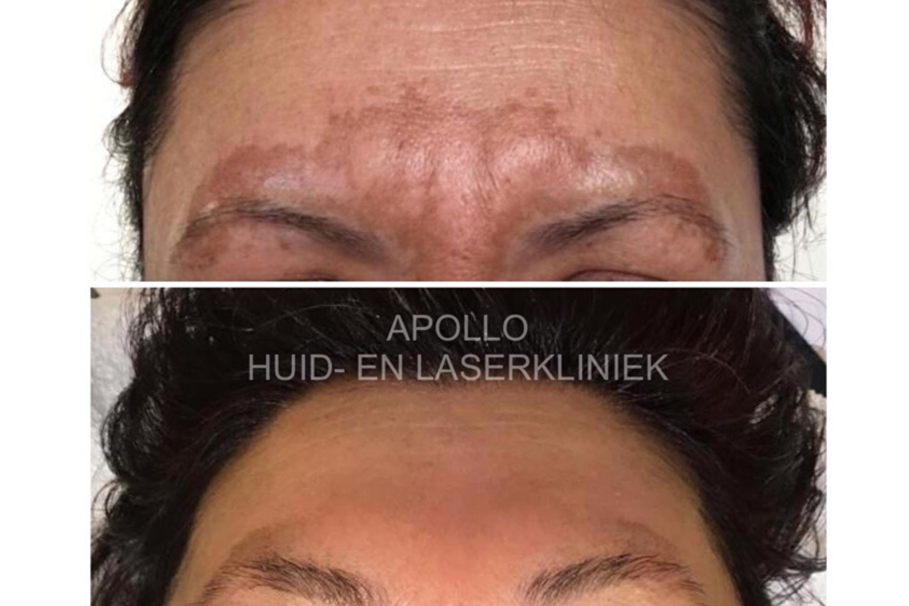 Pigmentbehandeling Voor en Na bij Apollo Beauty