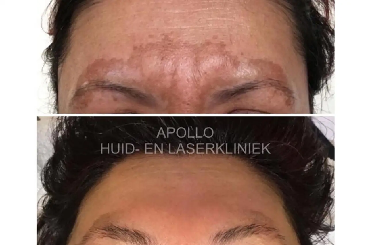 Pigmentvlekken laten verwijderen op je lichaam