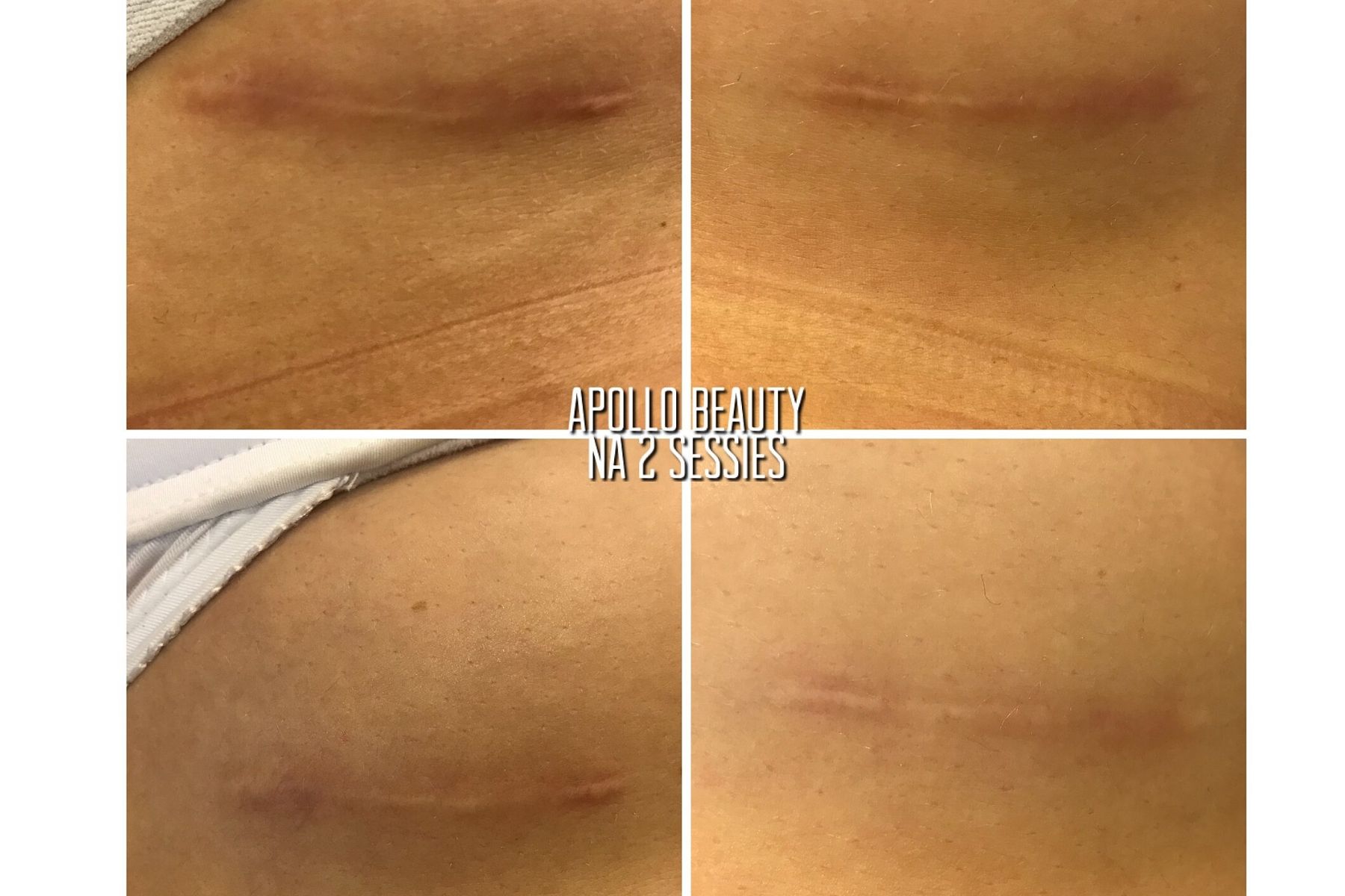 Voor En Na Foto Fractional Laserbehandeling Littekens 1