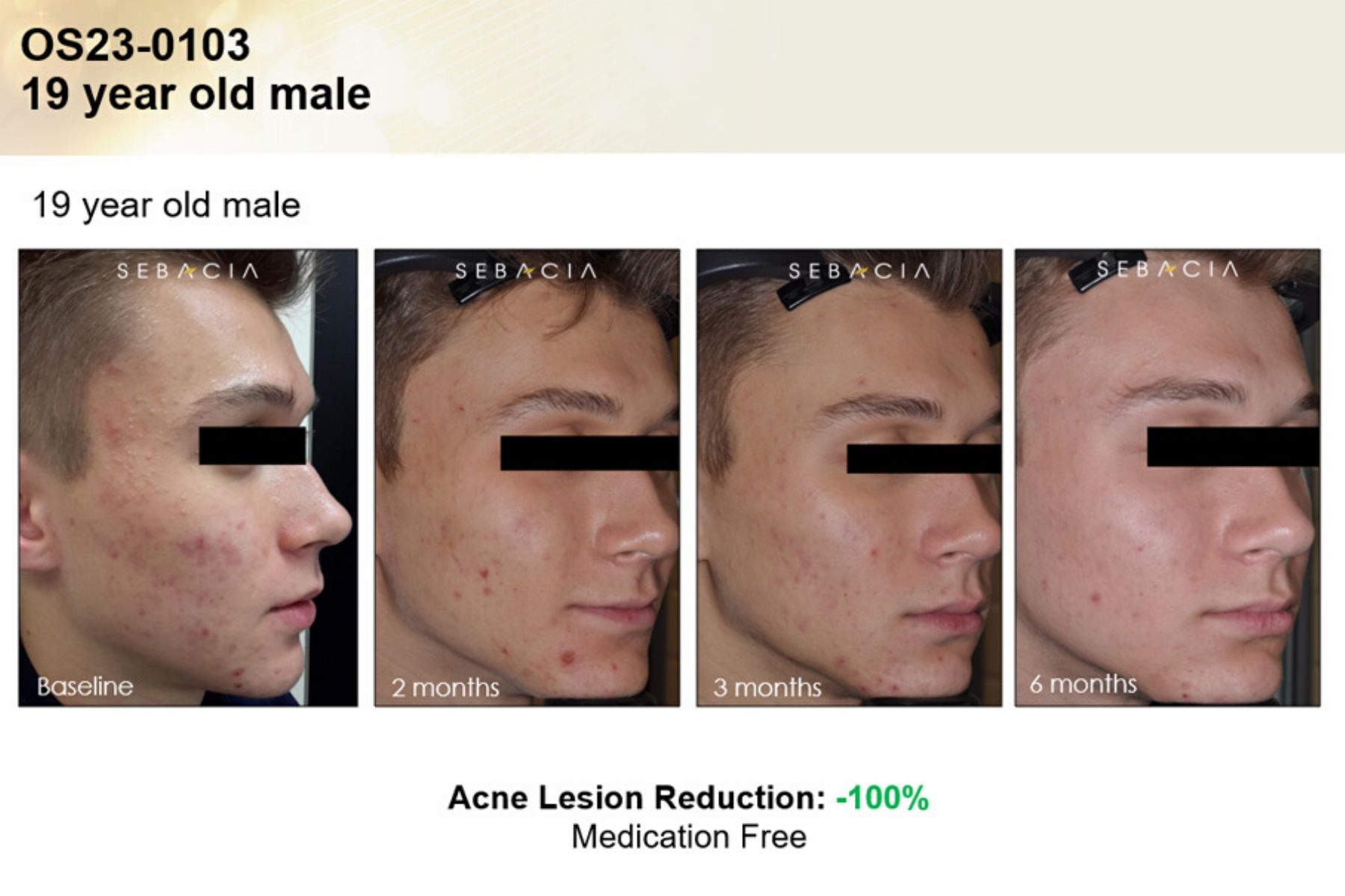 Voor En Na Foto Sebacia Acne 6