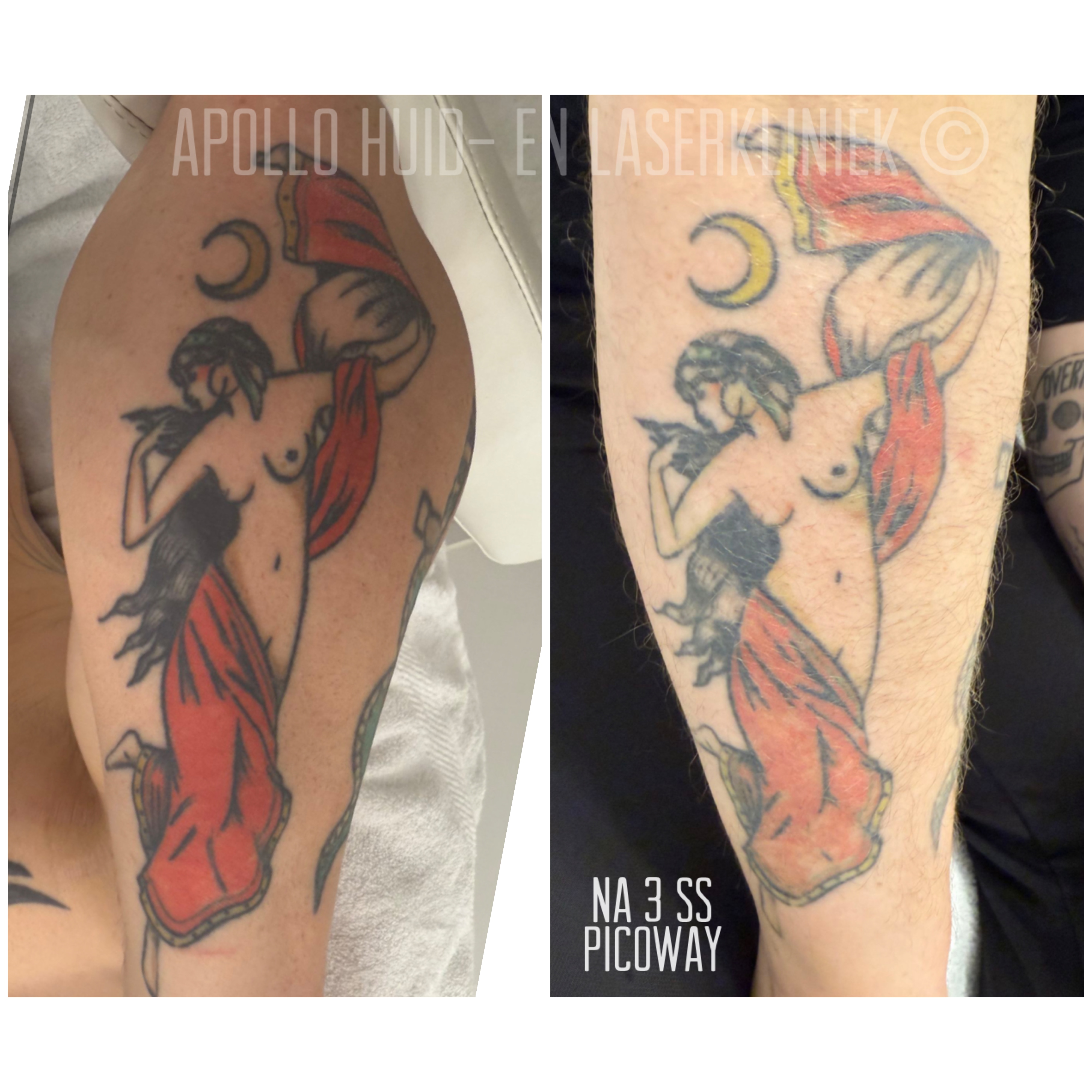 Resultaat na 3 sessies picoway laser om tattoo te laten verwijderen in Rotterdam