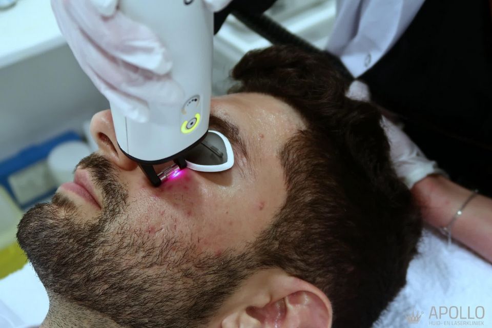 Fractional Laserbehandeling 2
