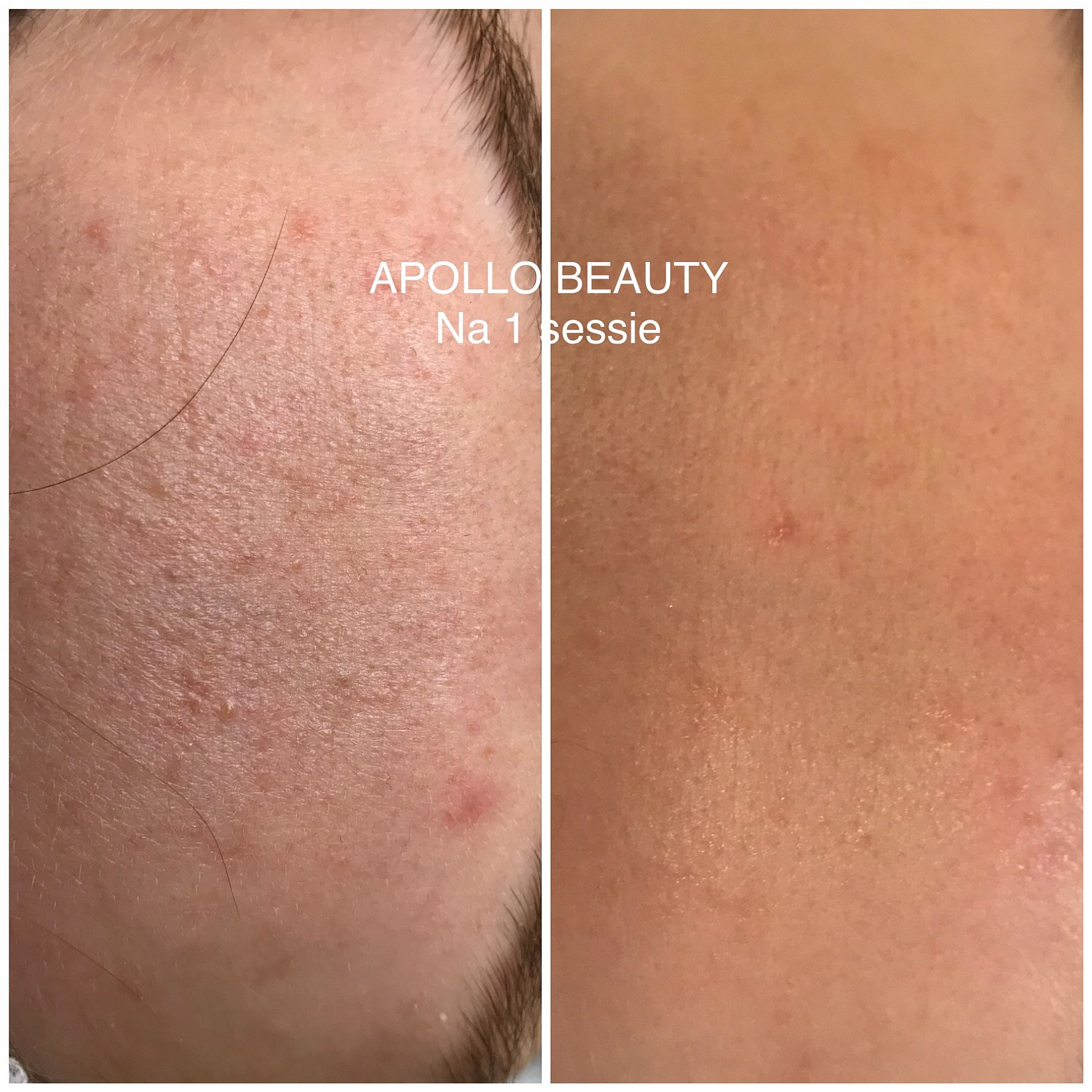 Fractional LASER Grove Porien