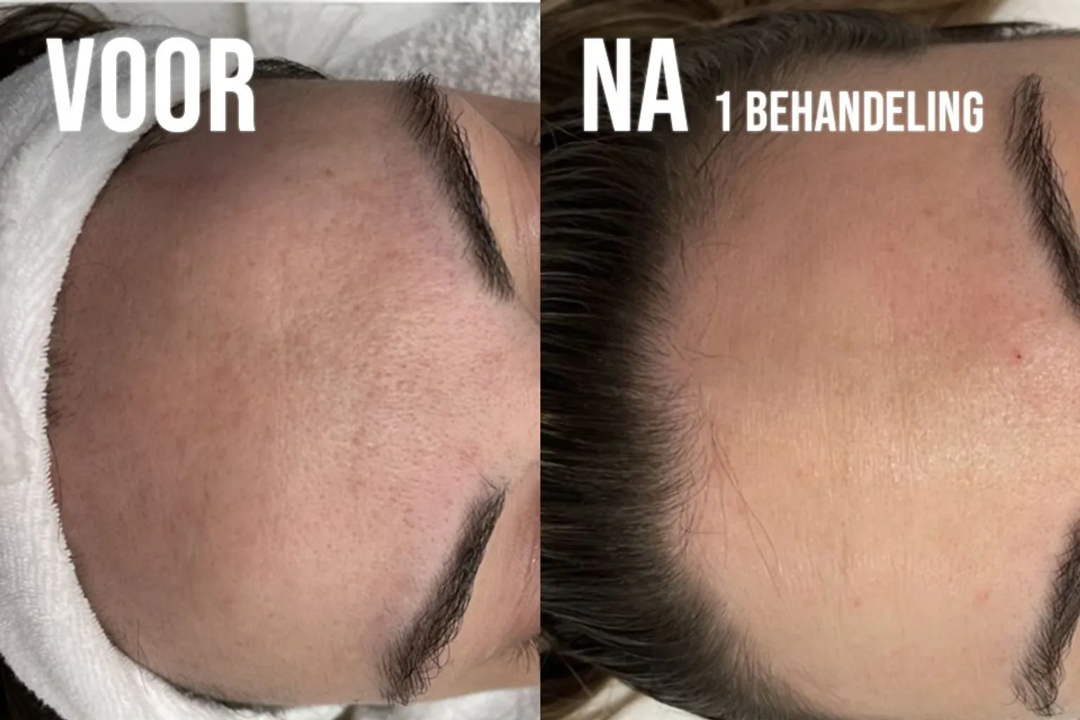 Vergelijking voor en na behandeling van grove poriën met zichtbaar gladdere huidstructuur.