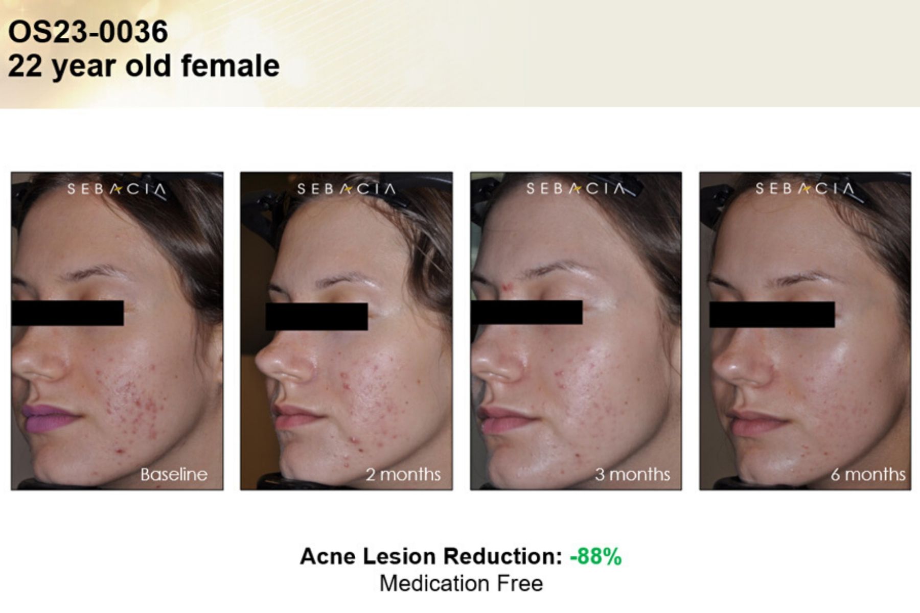 Voor En Na Foto Sebacia Acne 8