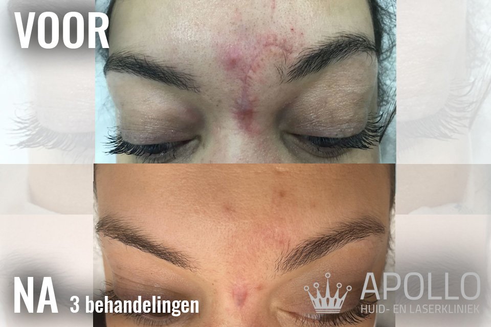 Factional LASER Apollo Voor Na Logo