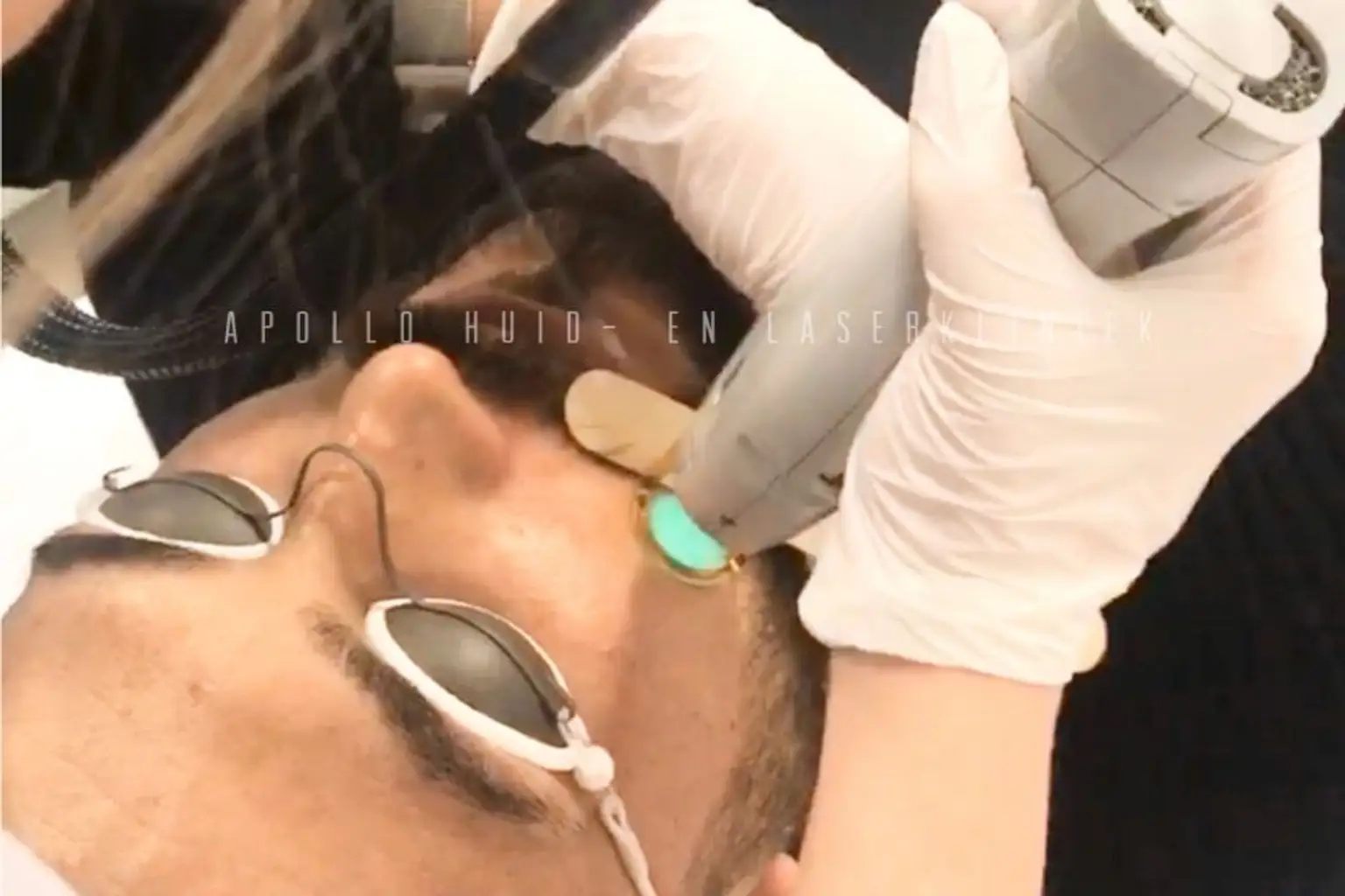 Laser ontharen bij klant in Rotterdam