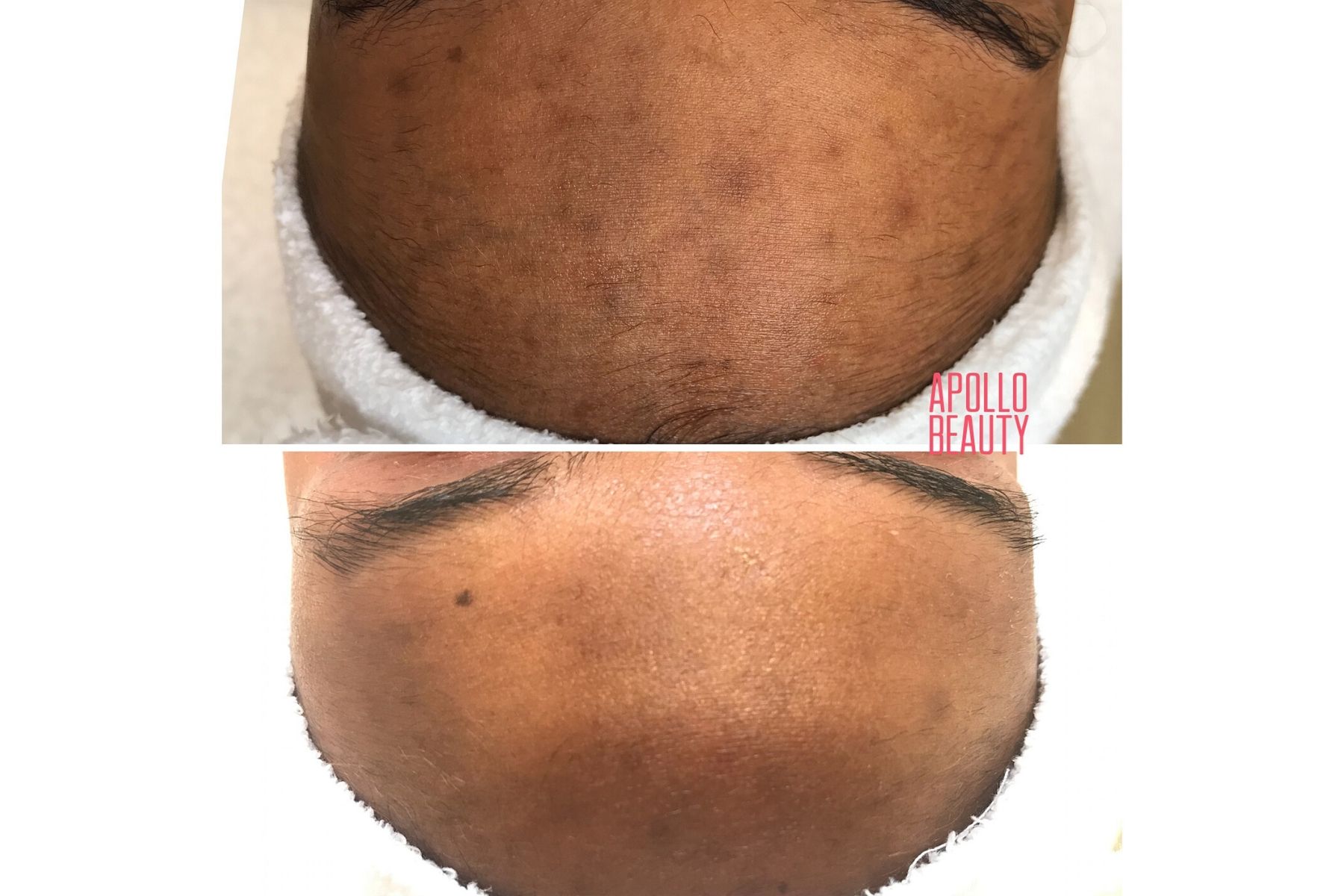 Pigmentvlekken verwijderen voor en na foto voorhoofd