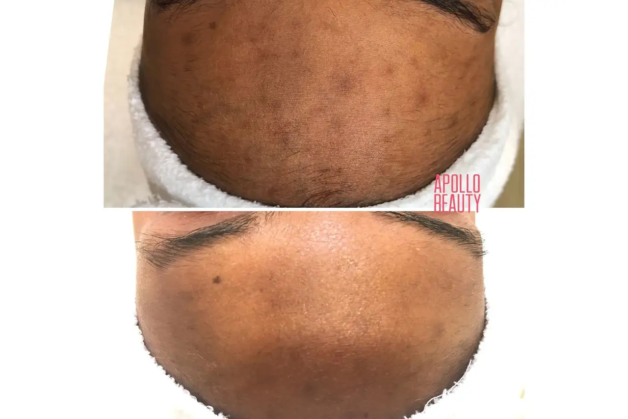 Pigmentvlekken verwijderen voor en na foto voorhoofd