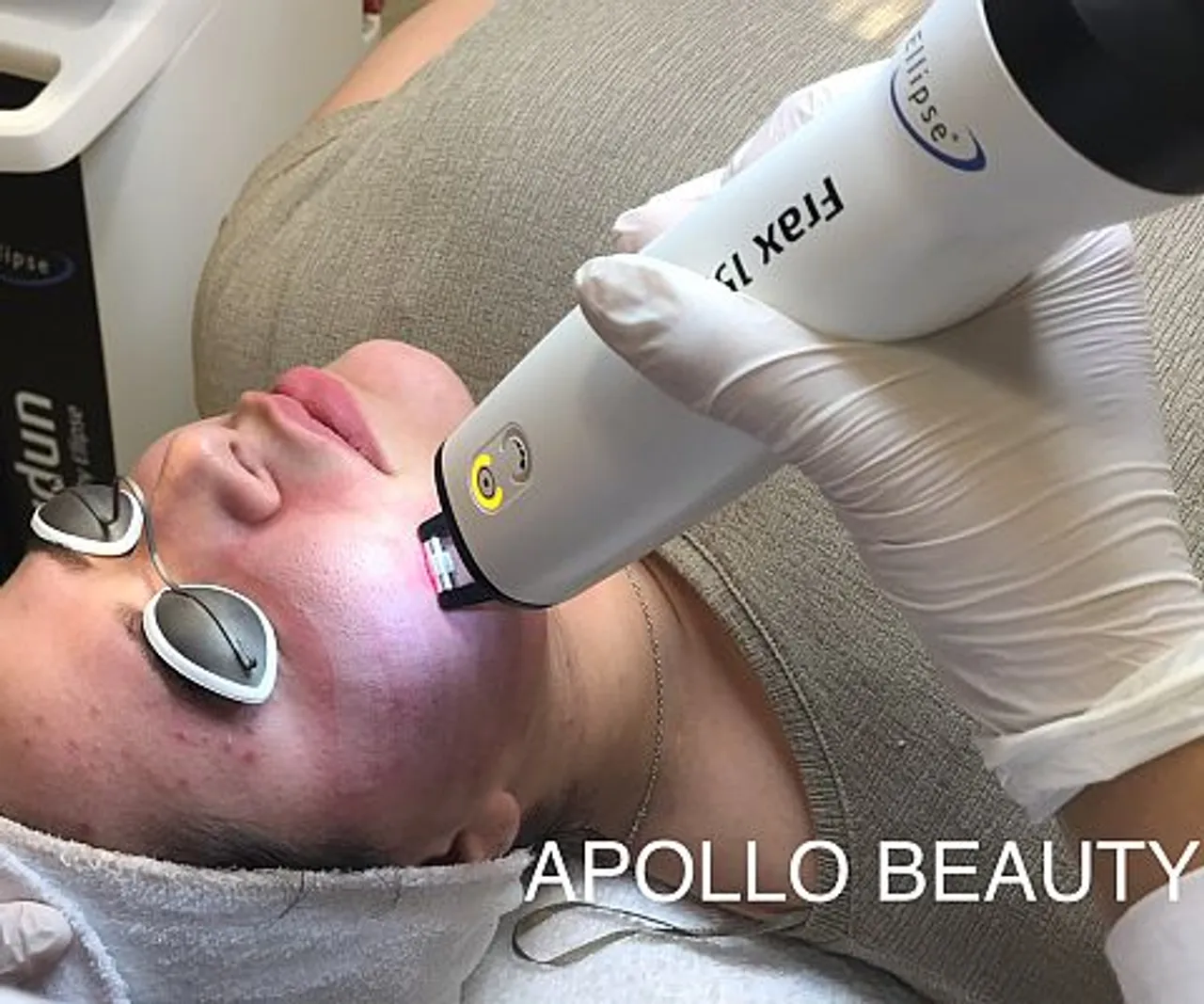 Fractional laserbehandeling in uitvoering bij Apollo Beauty, gericht op huidverjonging en littekenvermindering.