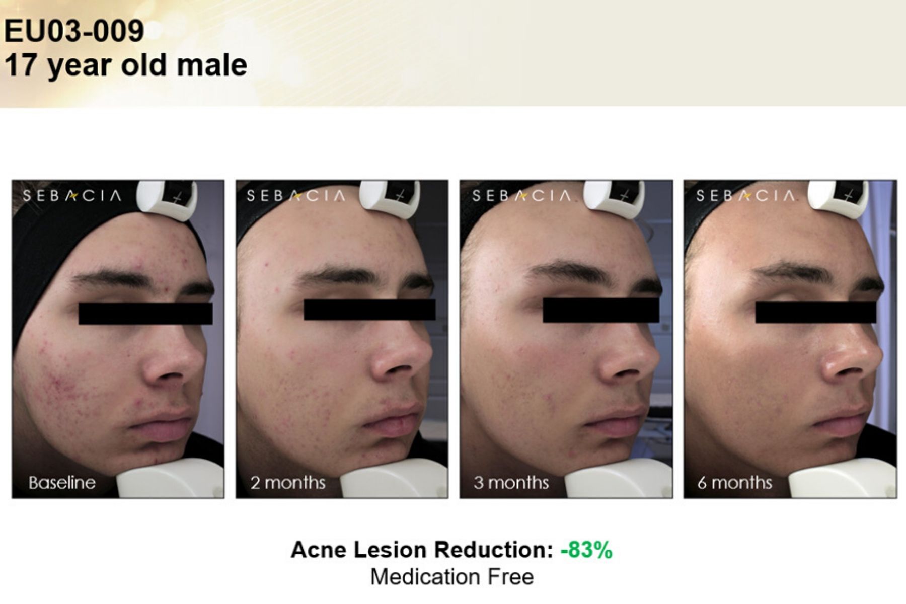 Voor En Na Foto Sebacia Acne 7