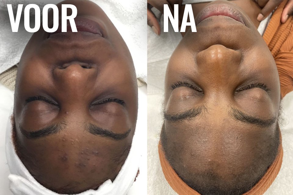 Resultaat van chemische peeling: huid oogt frisser, egaler en verfijnd na behandeling.
