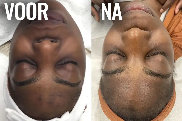 Resultaat van chemische peeling: huid oogt frisser, egaler en verfijnd na behandeling.