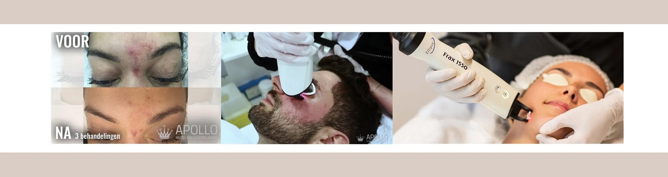 fractional laserbehandeling