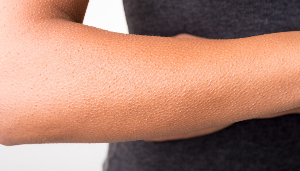 Keratosis Pilaris huidprobleem laten oplossen