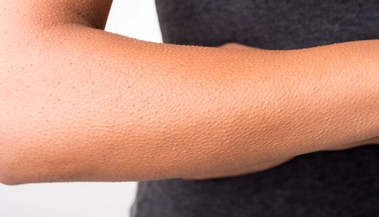 Keratosis Pilaris huidprobleem laten oplossen