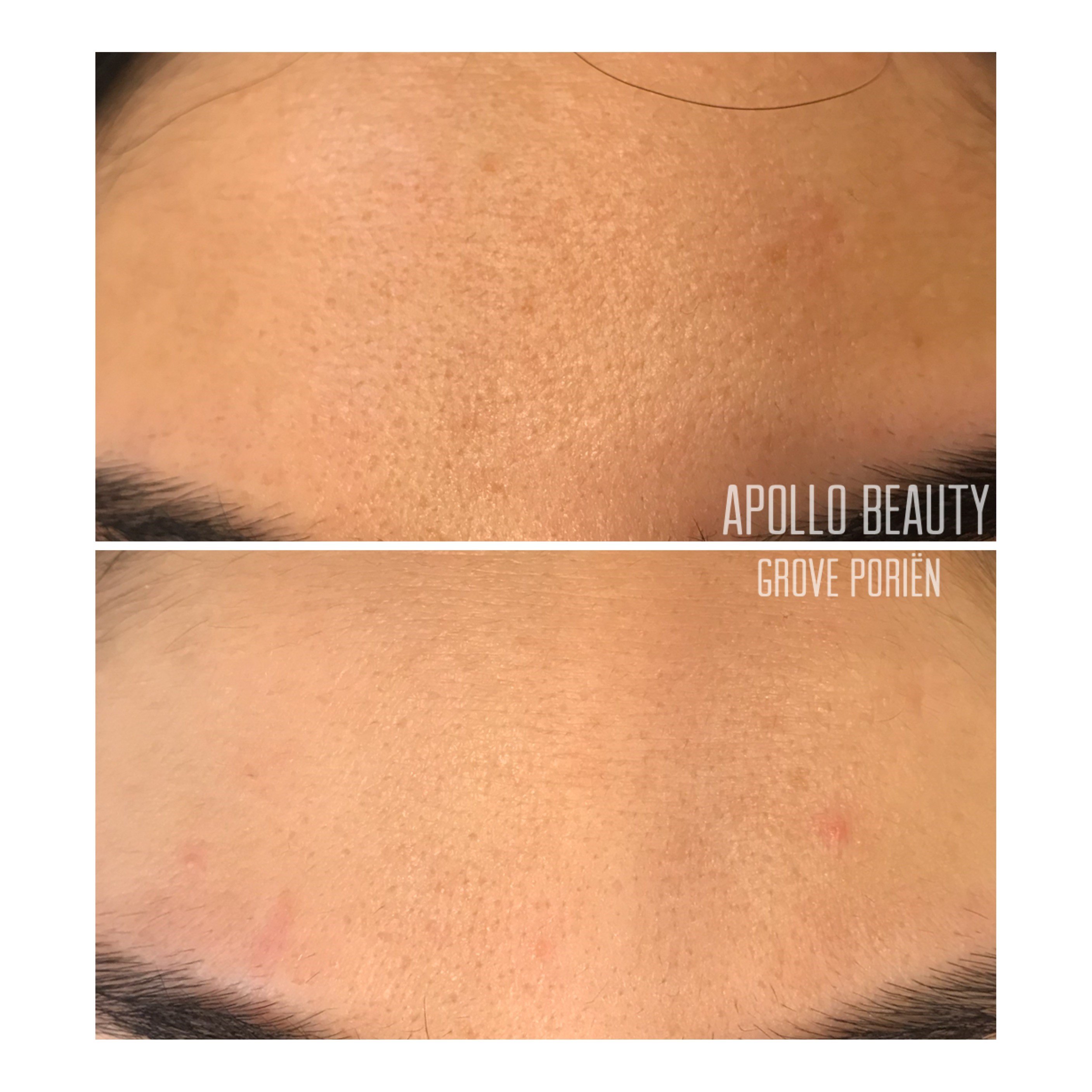 Fractional LASER Before After