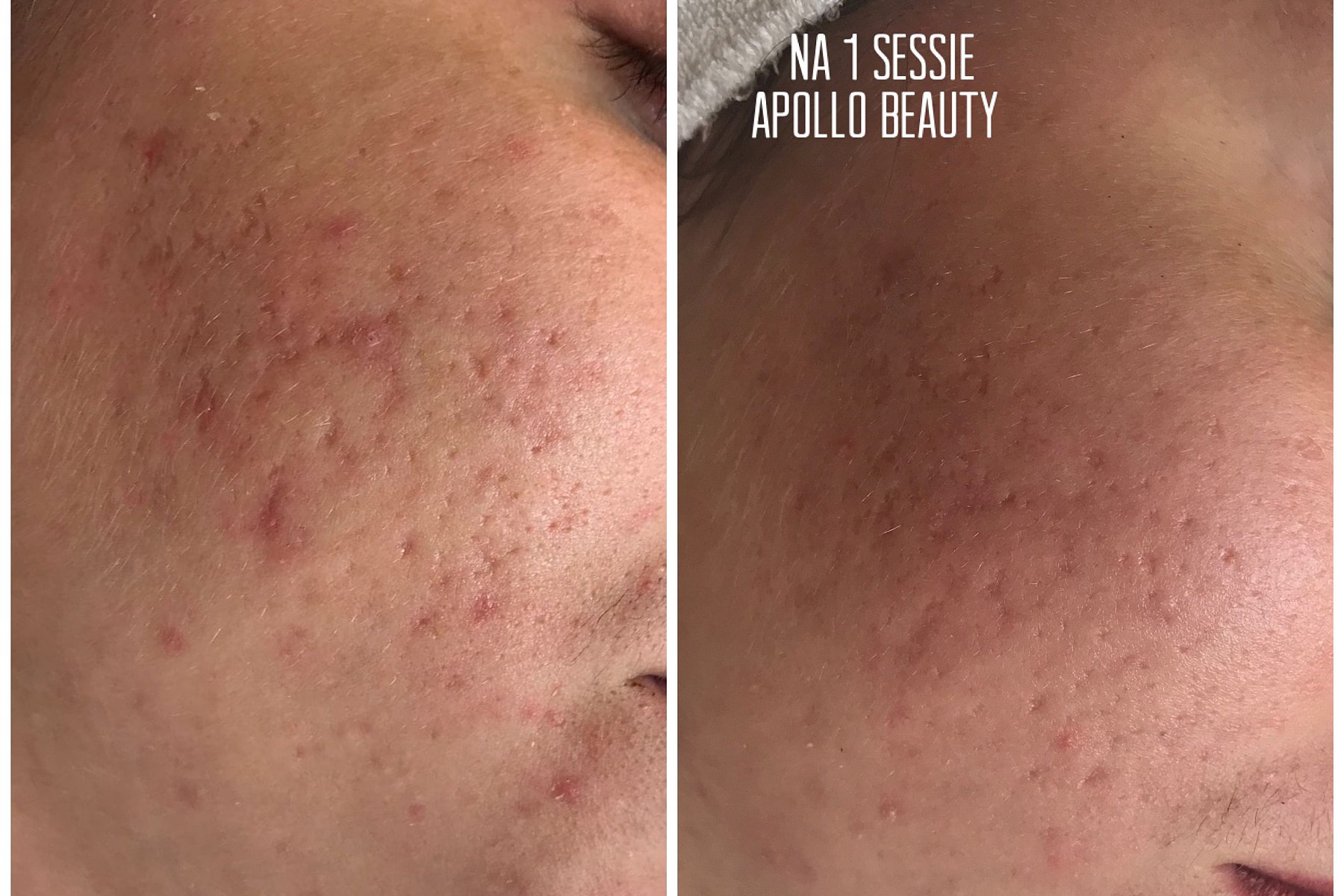 Fractional LASER Voor Na Acne