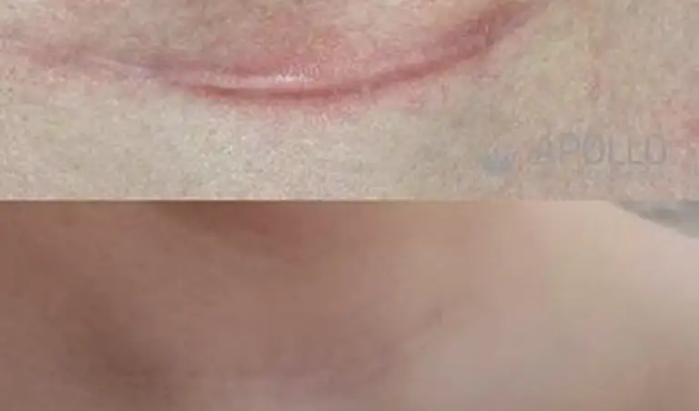 (Acne) Littekens