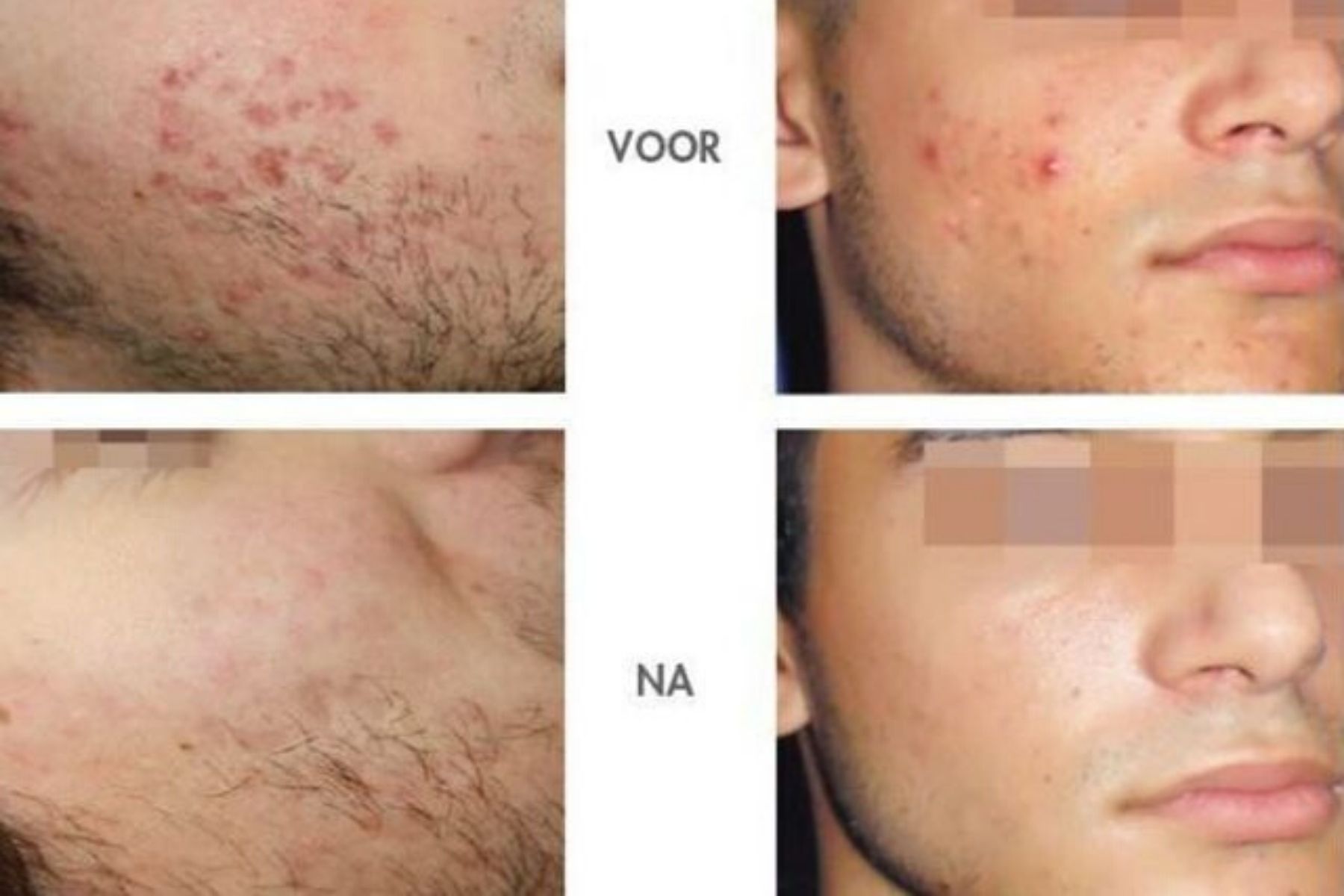 Voor En Na Foto Acne 3