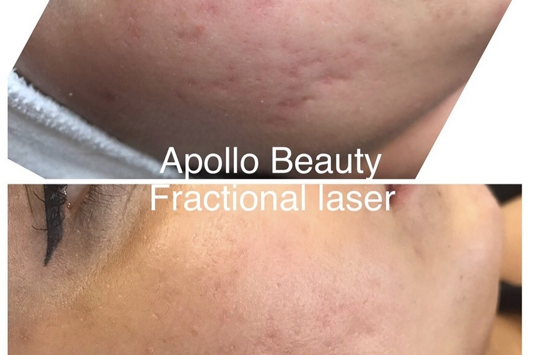 Fractional LASER Voor Na