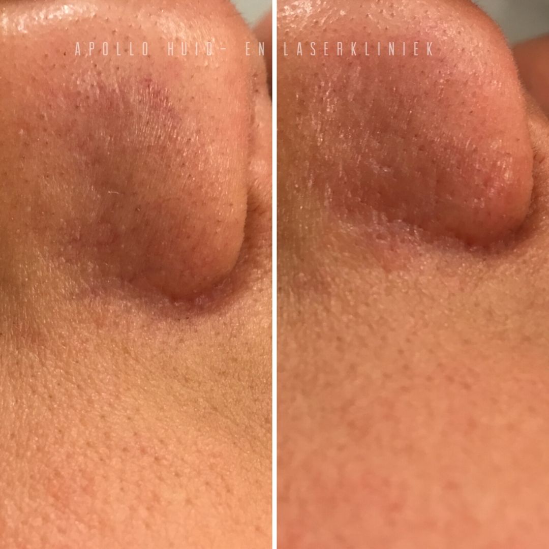 Vasculaire Behandeling 06