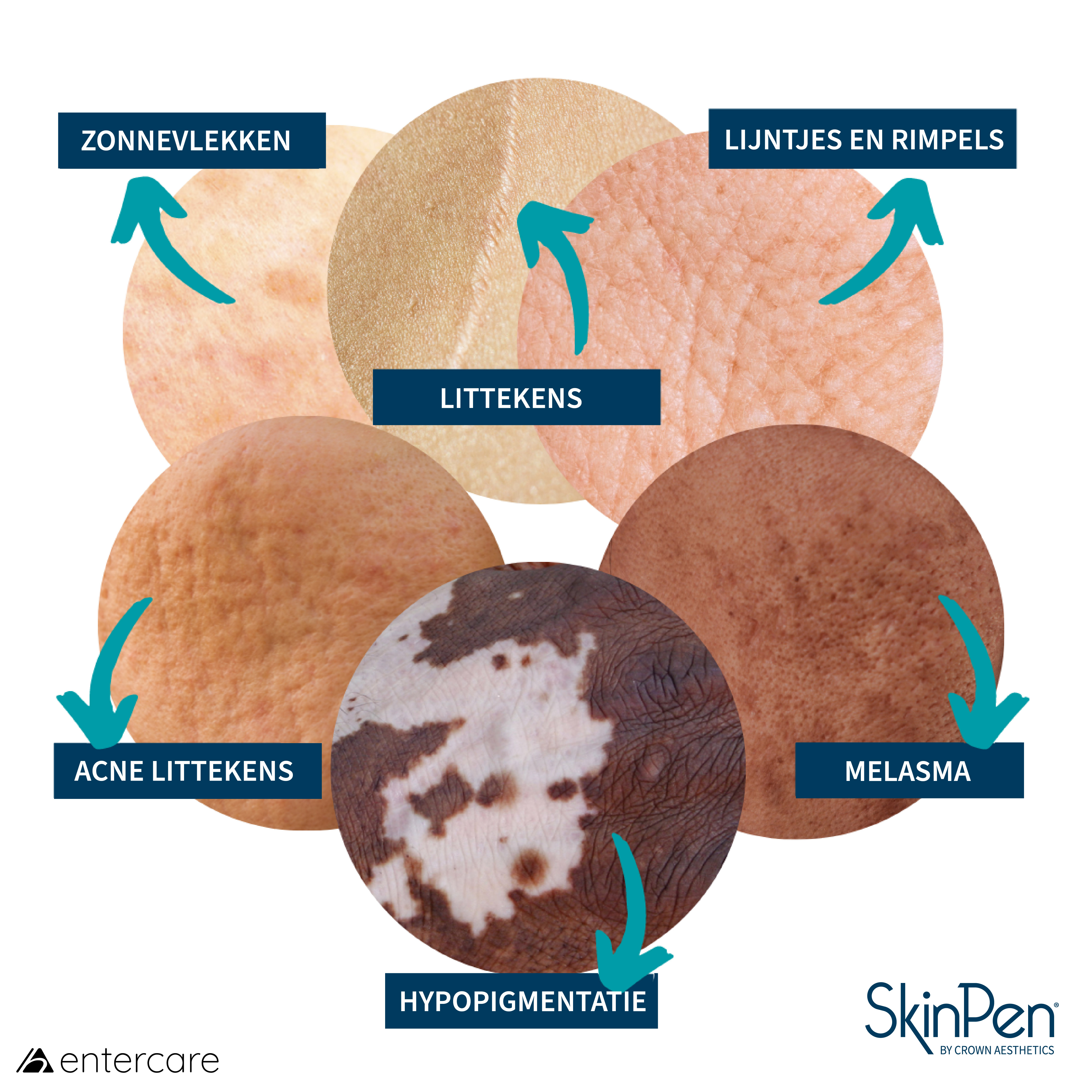 SkinPen indicaties overzicht