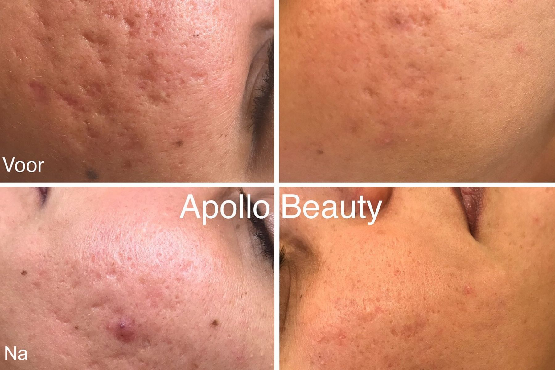 Voor En Na Foto Fractional Laserbehandeling Acne 3