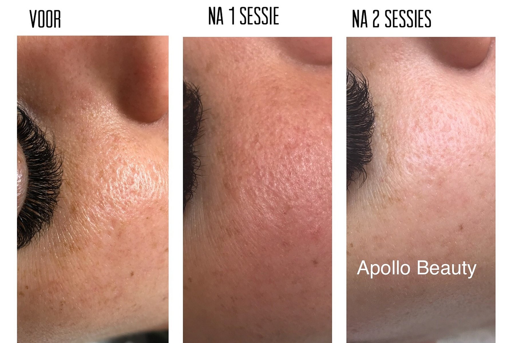 Fractional LASER Voor Na Grove Porien