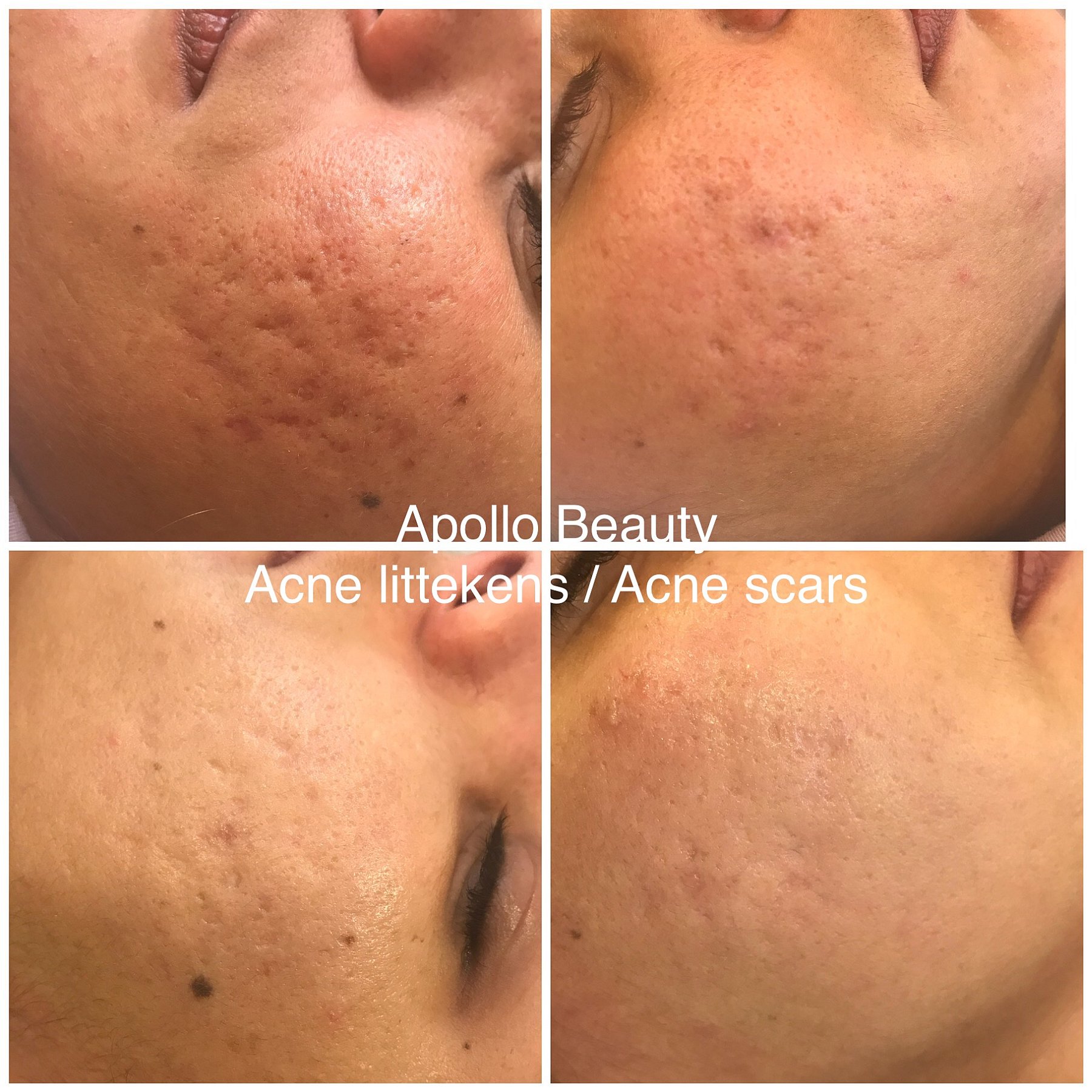Fractional LASER Voor Na Acne Littekens