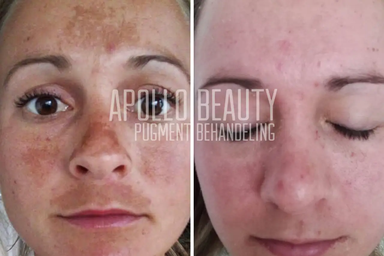 Pigmentbehandeling Voor en Na bij Apollo Beauty