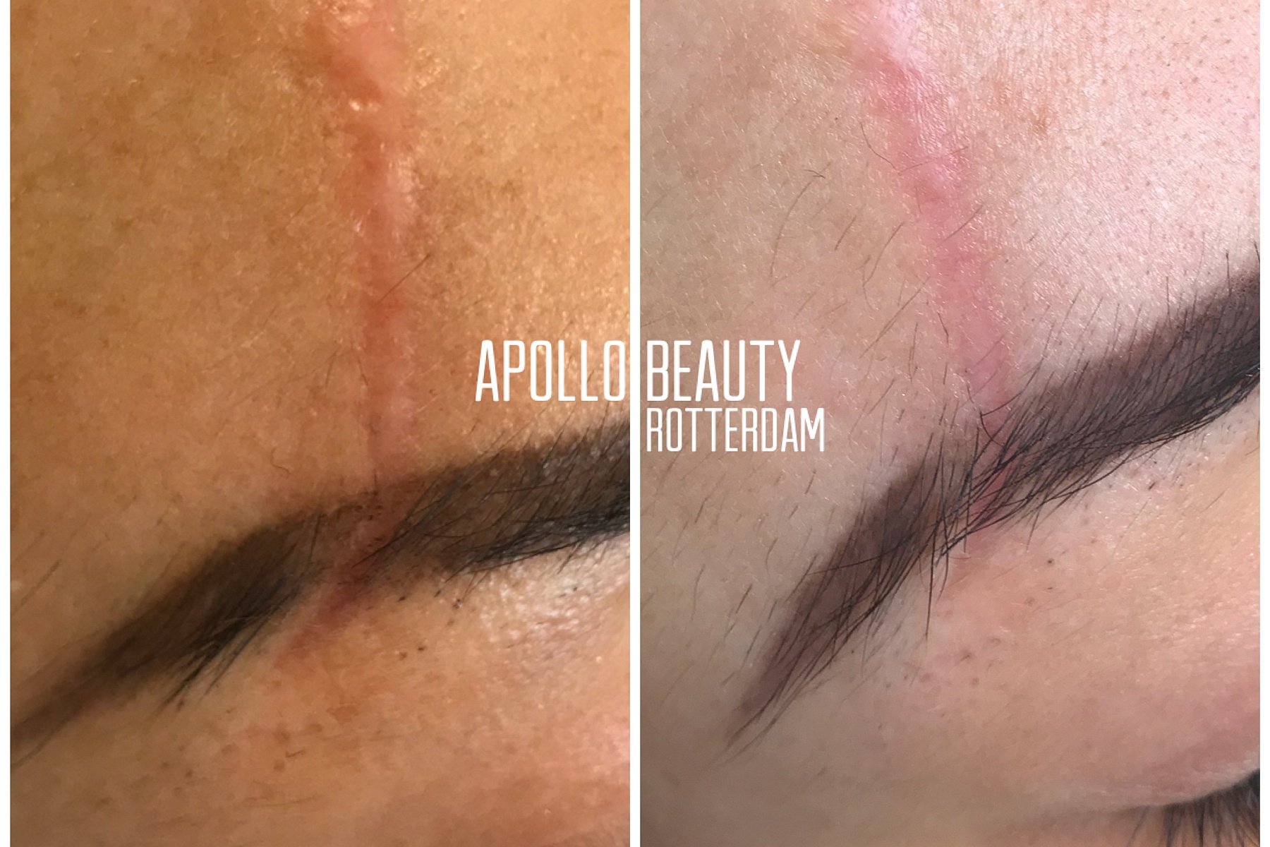 Fractional LASER Voor Na Litteken