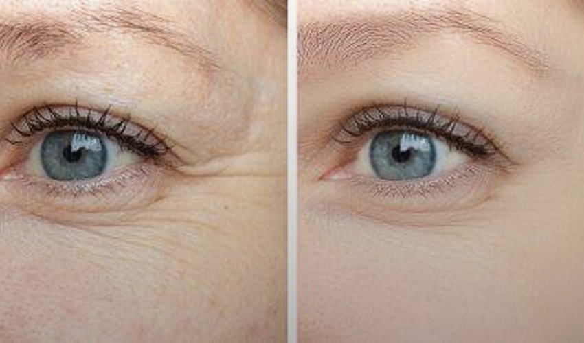 Rimpels en huidverslapping