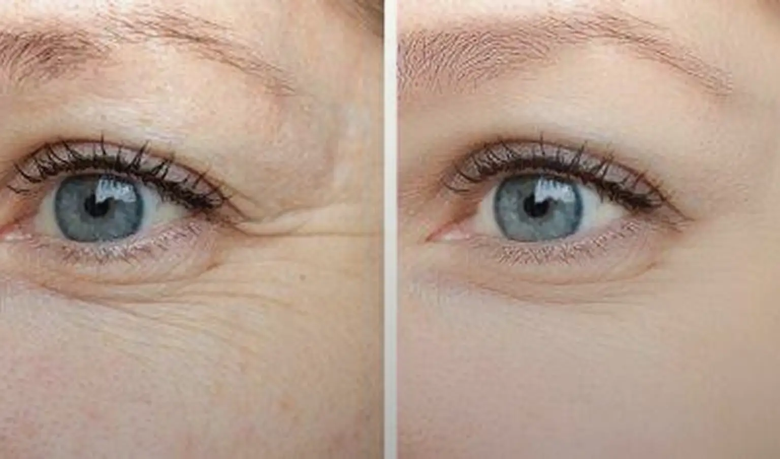 Rimpels en huidverslapping