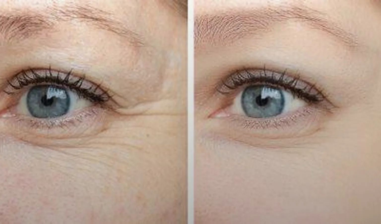 Rimpels en huidverslapping