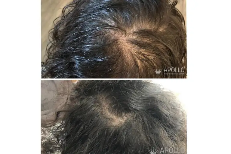 Mesotherapie Behandeling Tegen Haaruitval