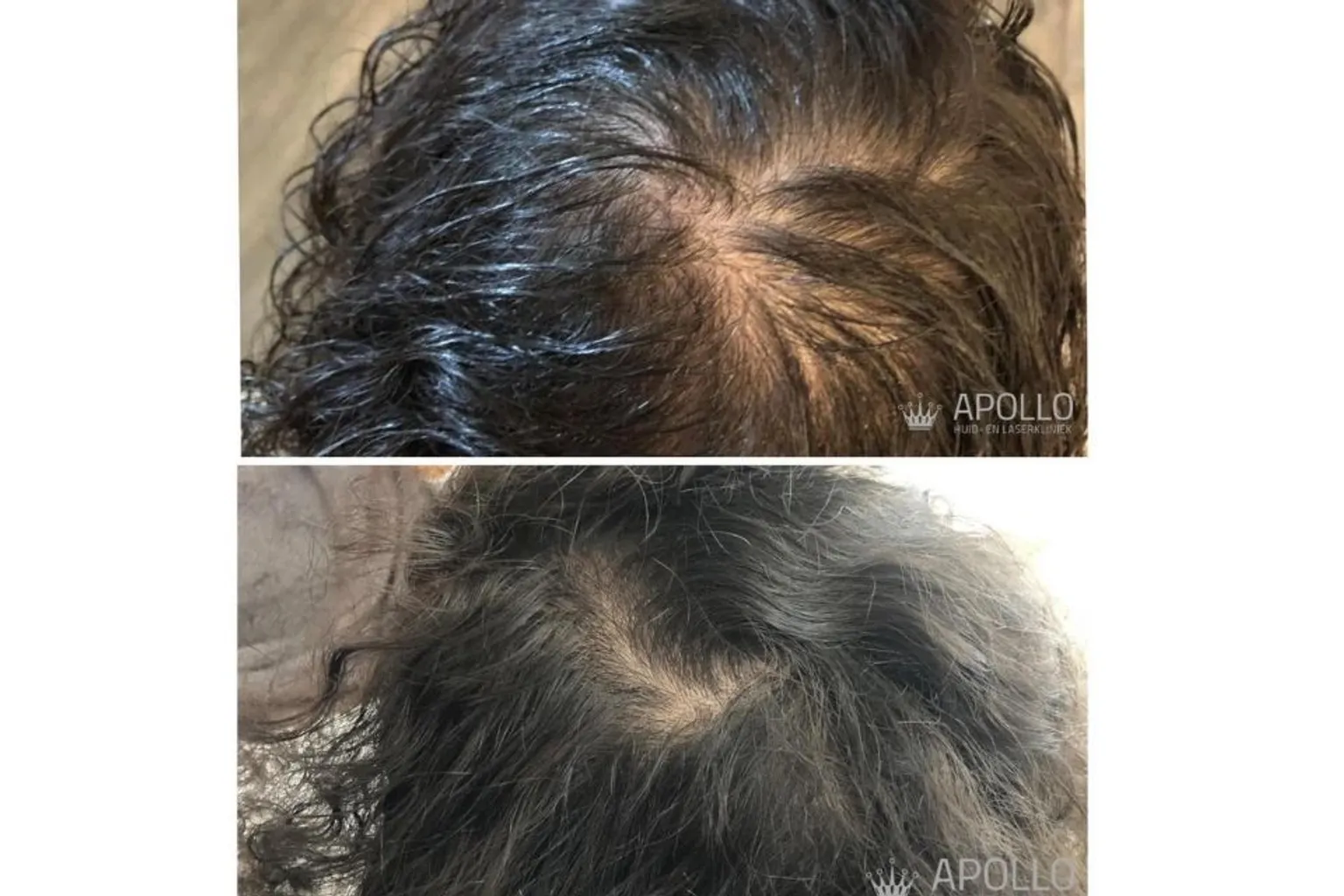 Mesotherapie Behandeling Tegen Haaruitval