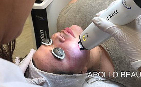 Prijzen fractional laser