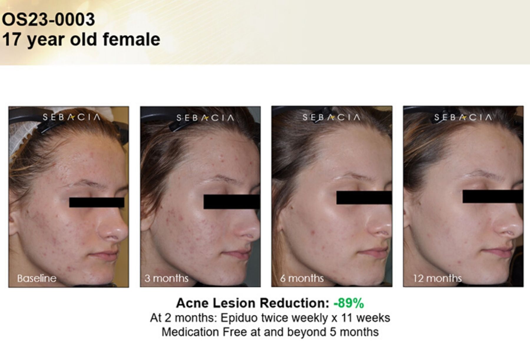 Voor En Na Foto Sebacia Acne 9