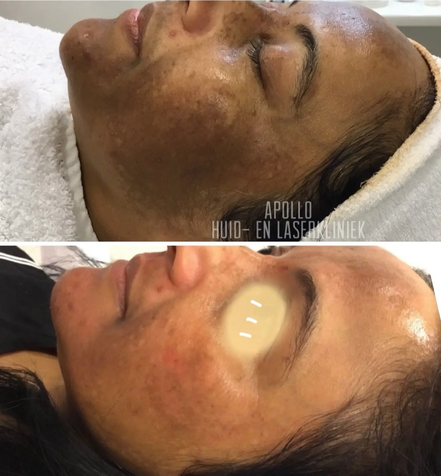 Huid met hyperpigmentatie voor behandeling bij Apollo Beauty.