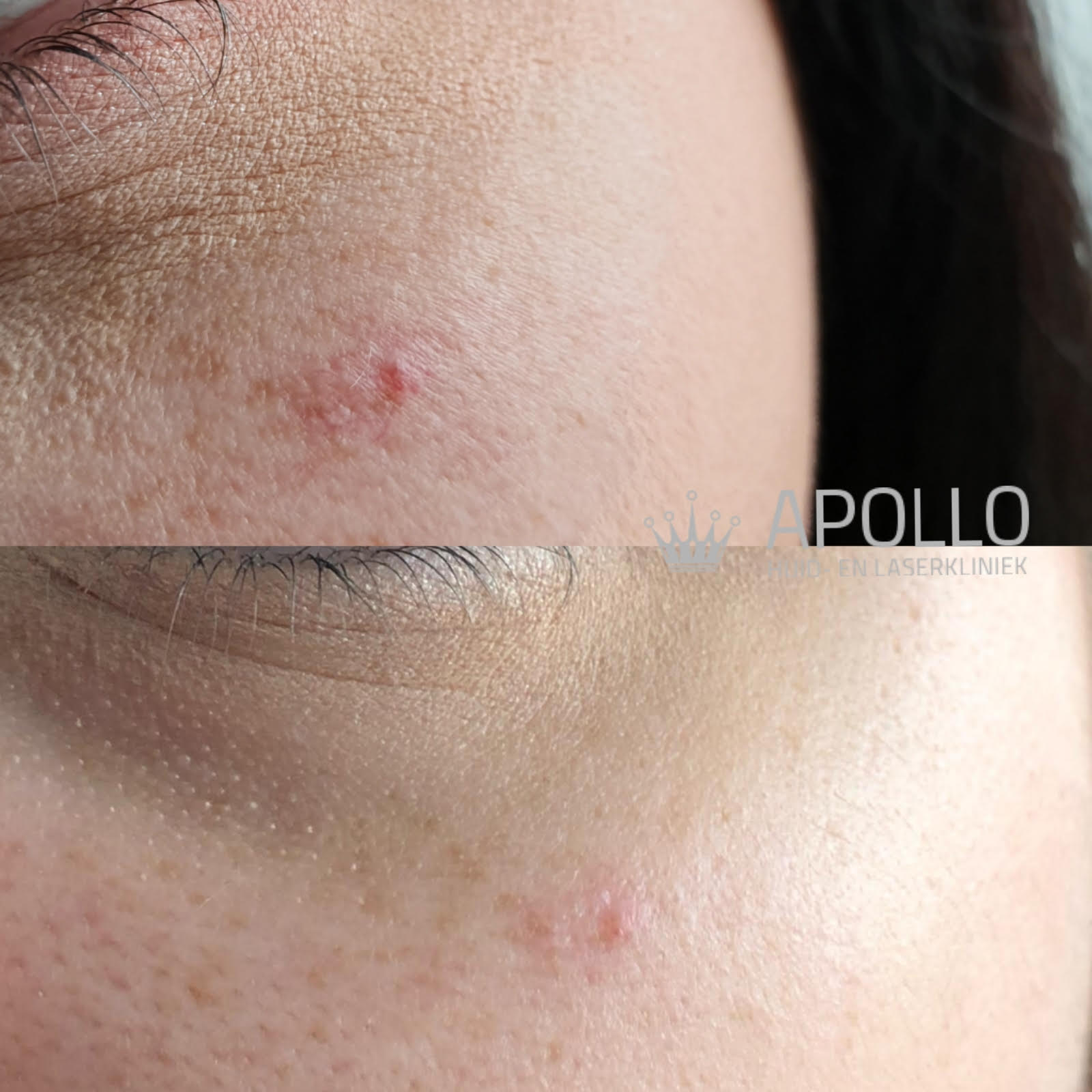 Vasculaire Behandeling 04