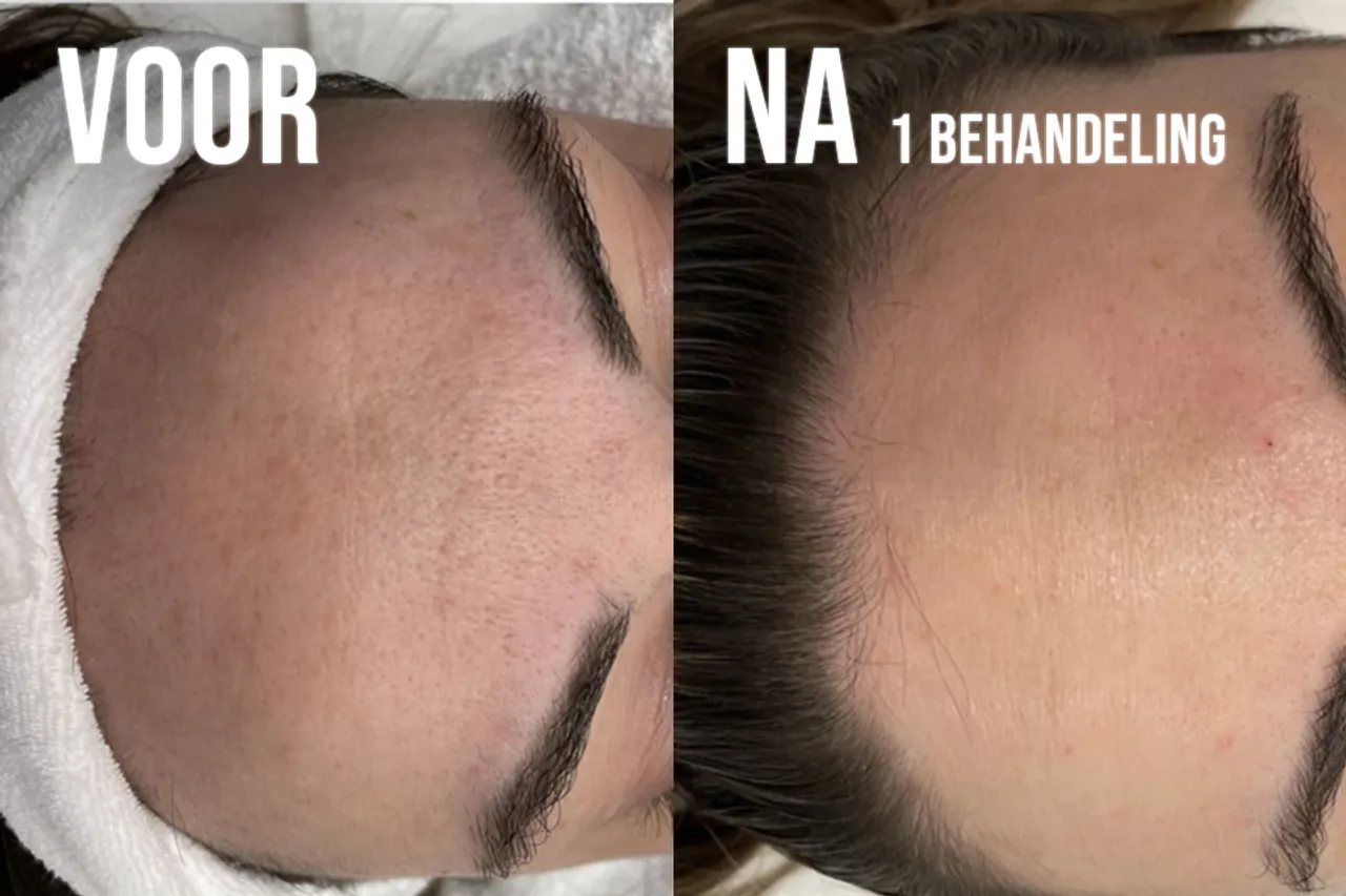 Voor en na foto van Grove poriën