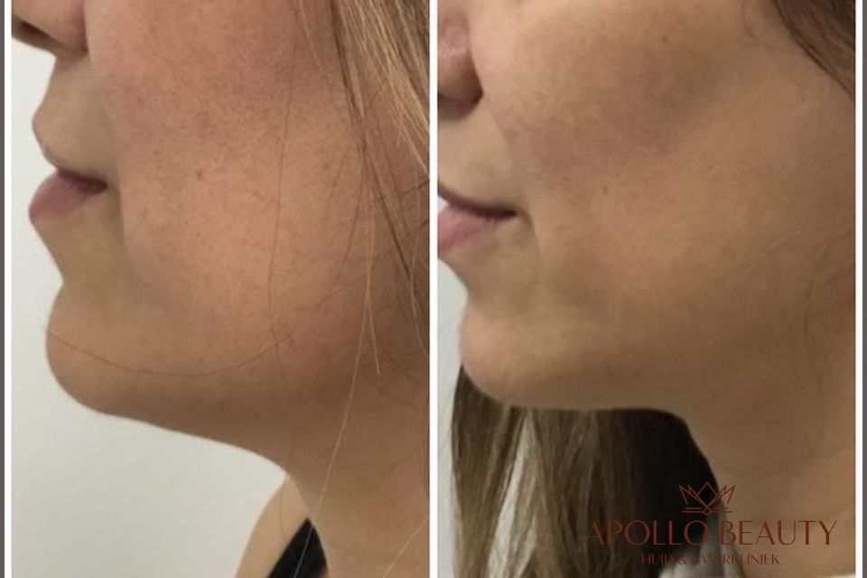 Resultaat Na 1 Hifu Behandeling Apollo Beauty 04