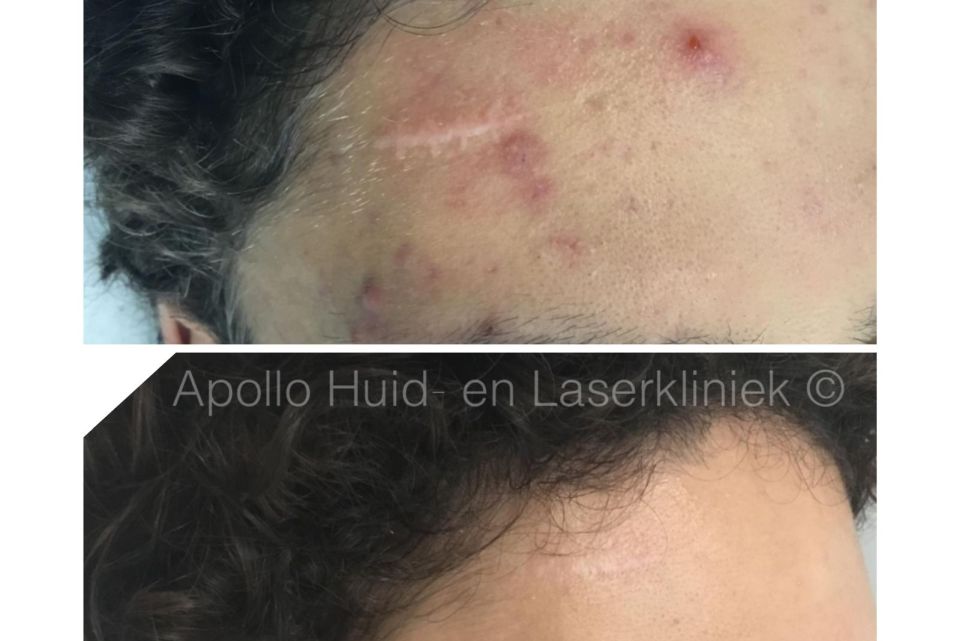 Apollo Beauty Resultaat Na 5 Sessies Fractional Laserbehandeling