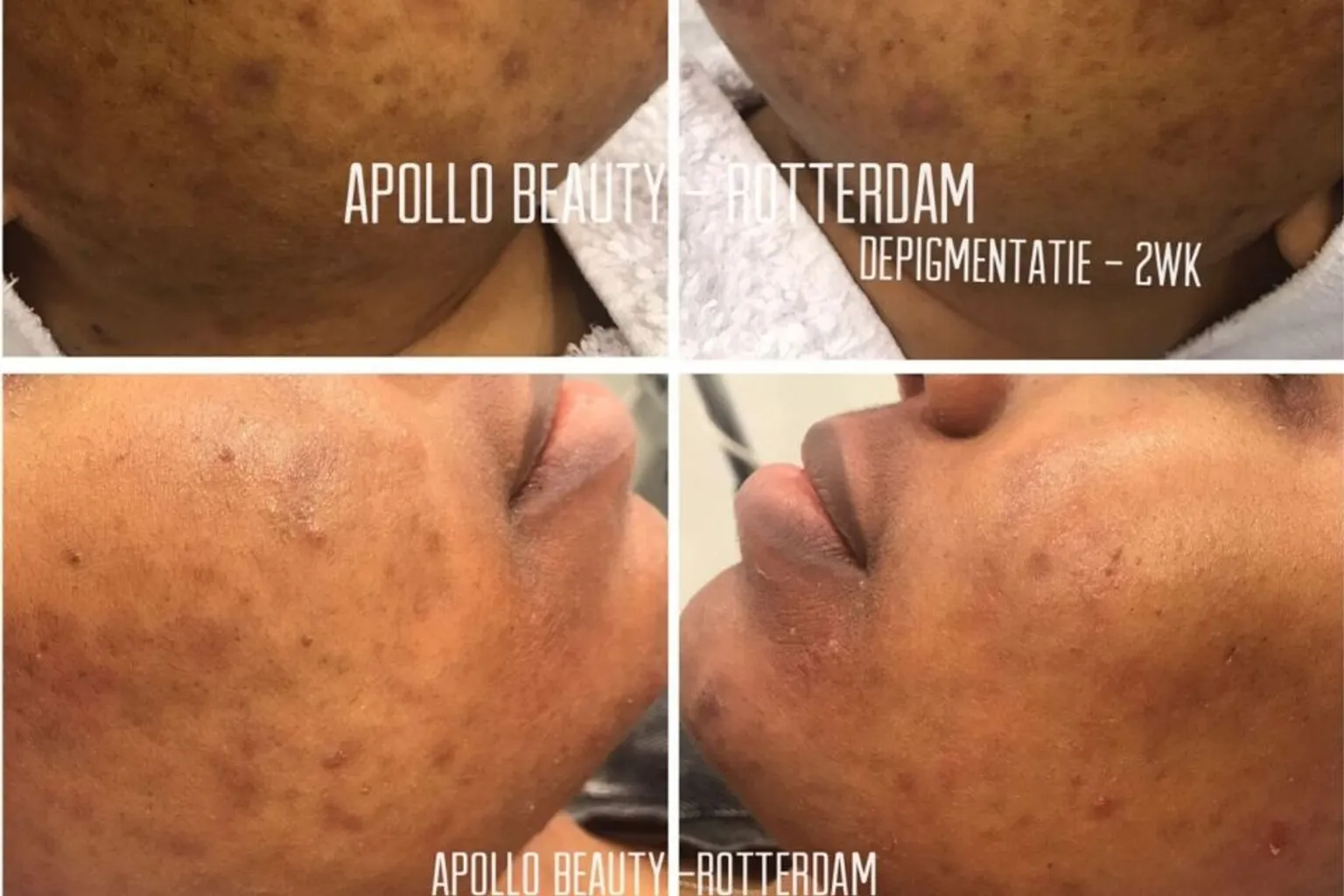 Voor- en na resultaat van Cosmelan pigmentbehandeling met duidelijke vermindering van vlekken.